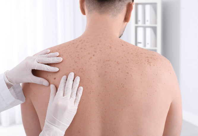Médico examinando lunares en espalda para prevenir el cáncer de piel.