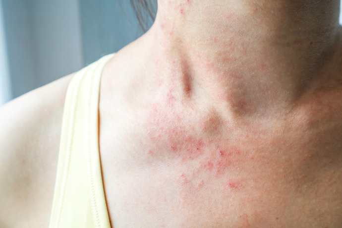 La dermatitis puede ser otro síntoma de falta de vitamina D.